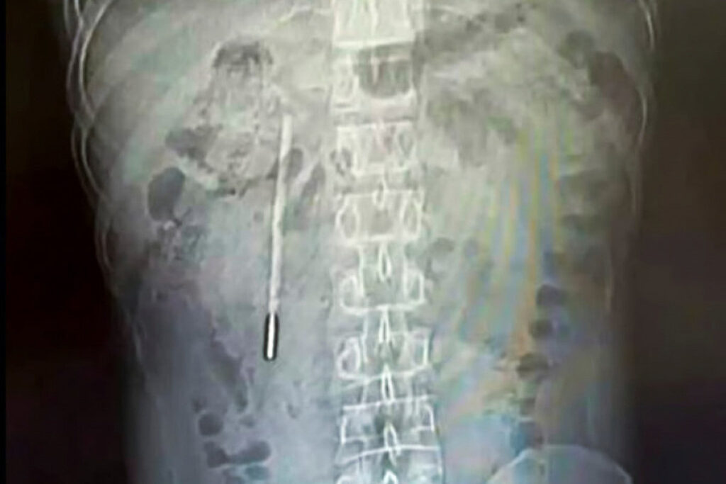 Xitoyda erkak 20 yil davomida ichakda termometr bilan yashagan / Foto: Weibo