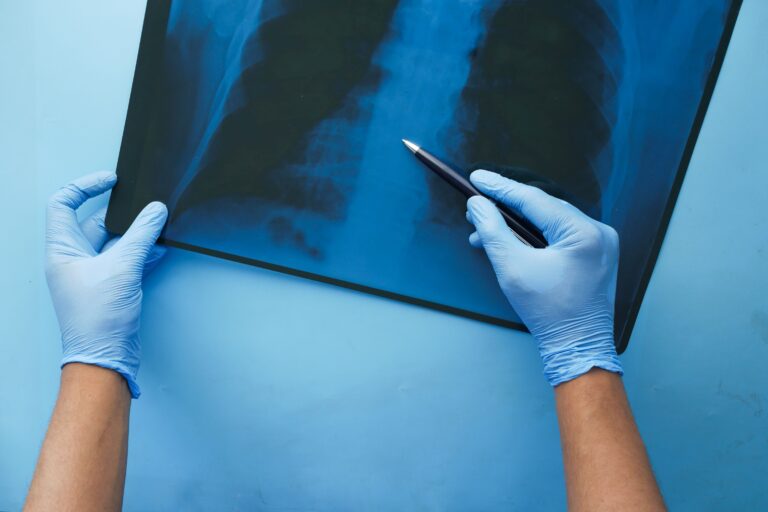 TB continued? Antibiotic-resistant tuberculosis discovered in Europe